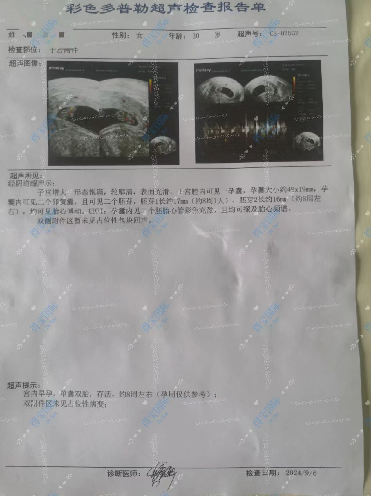 多囊案例30y